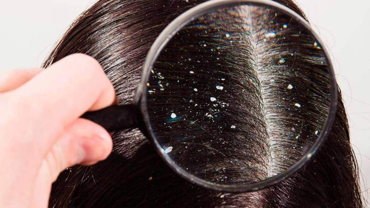 Dandruff treatment, forget about it forever